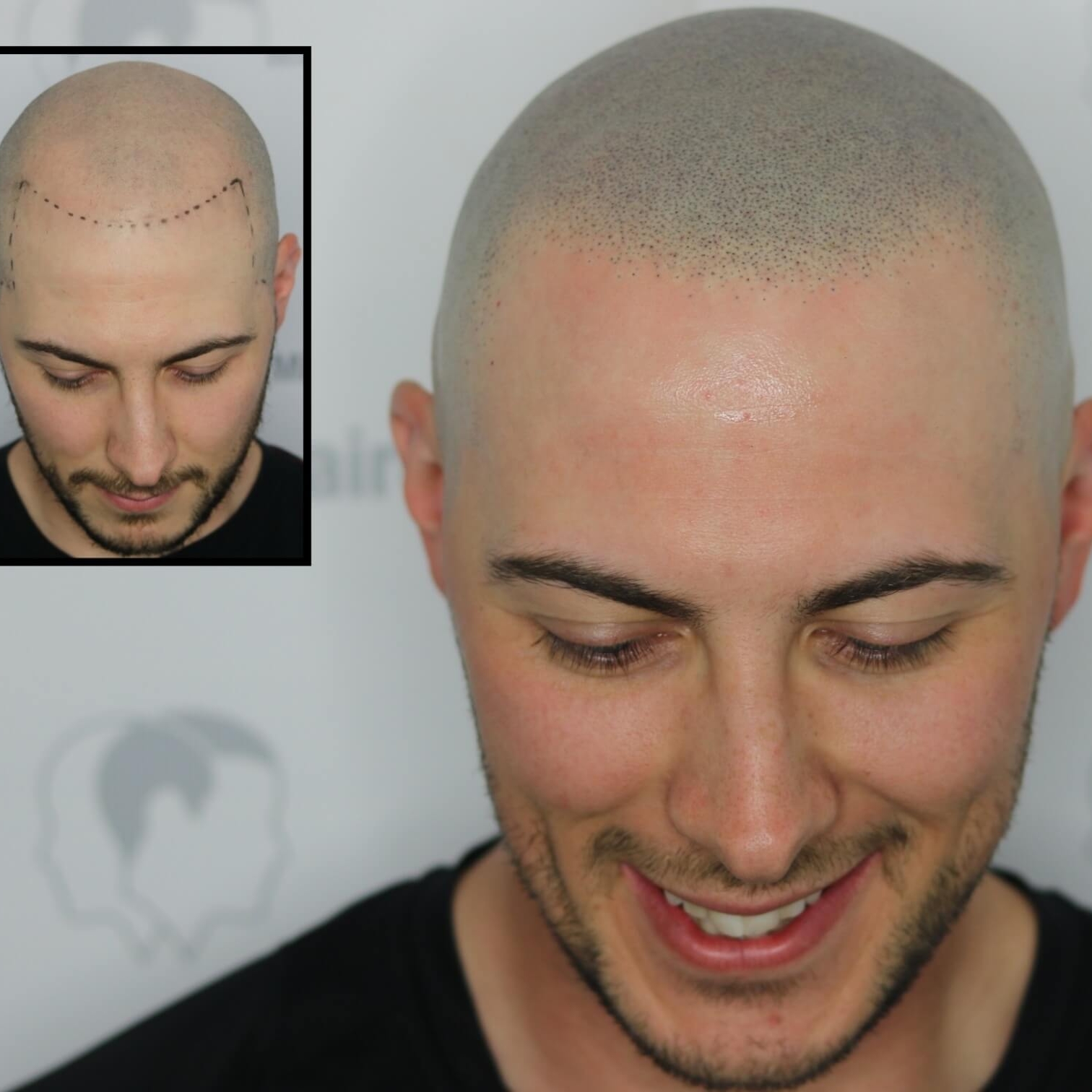 scalp micropigmentation capillaire
